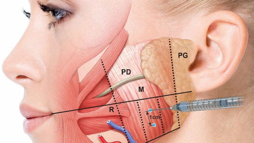 Çene Botoksu (Diş Sıkma Botoksu)